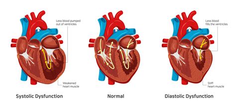 left ventricular diastolic dysfunction symptoms.